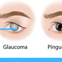 Glaucoma Test